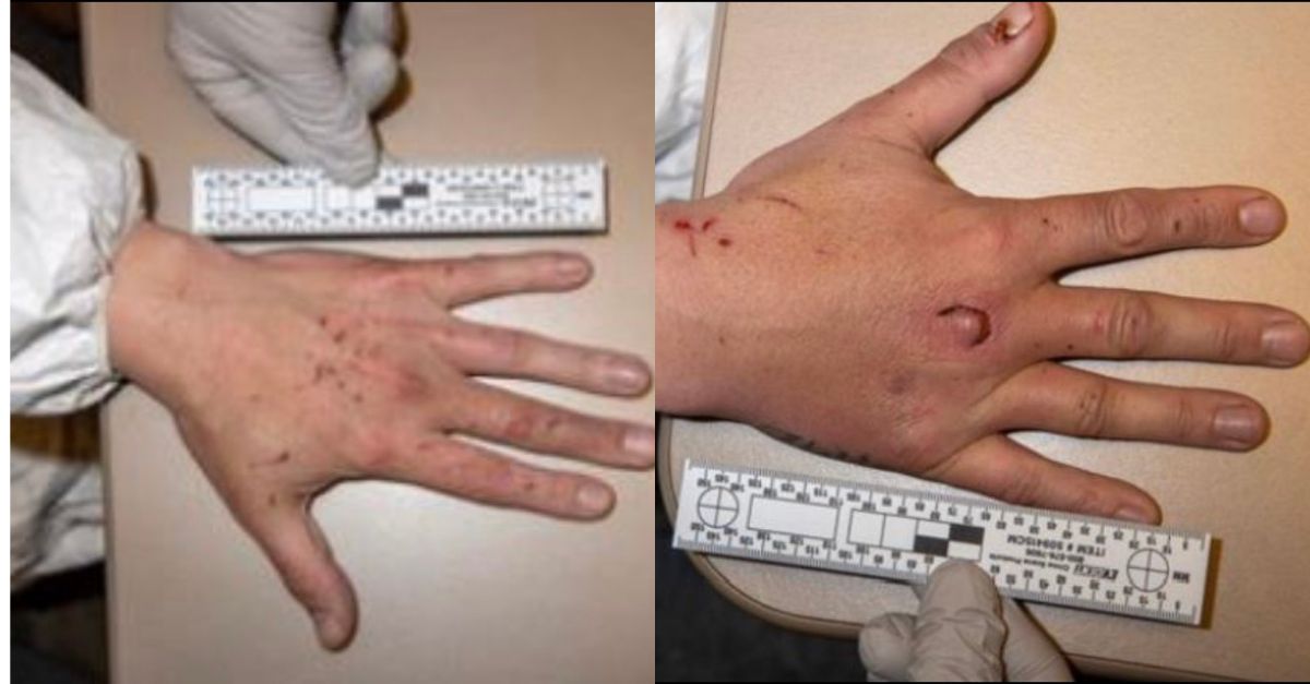 Injuries to Gitchel's hand (Seattle Police Dept.)
