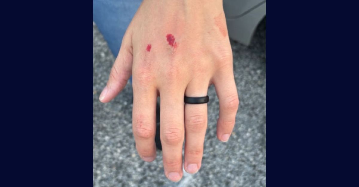 Court exhibit of injury Sydney Lori Reid allegedly inflicted upon an FBI agent.